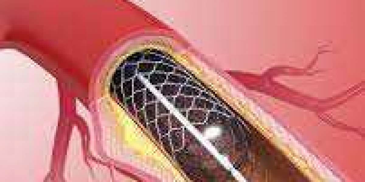 Expert Coronary Angioplasty in Jaipur: Advanced Treatment for Heart Health