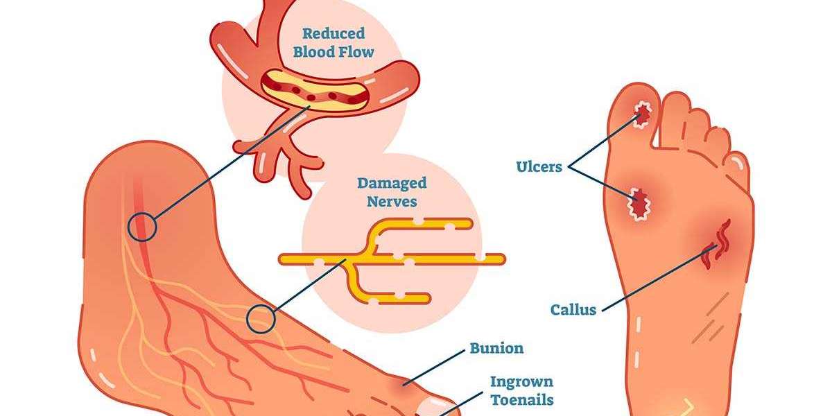 Diabetic Foot Ulcers Drug Pipeline Analysis