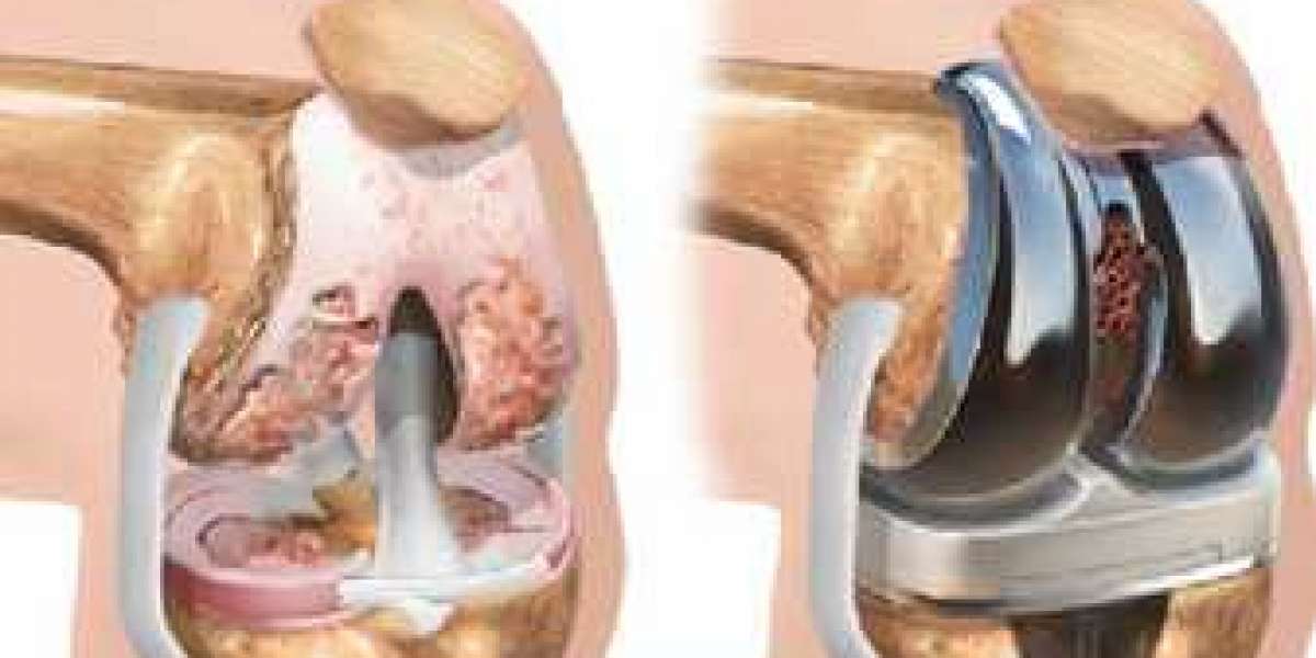 How Long Does It Take To Recover From Knee Replacement Surgery